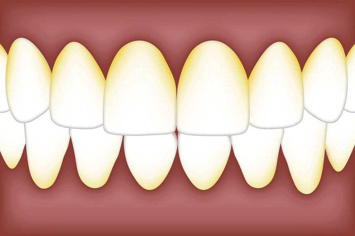 Tartaro sui denti: come toglierlo da soli e dal dentista
