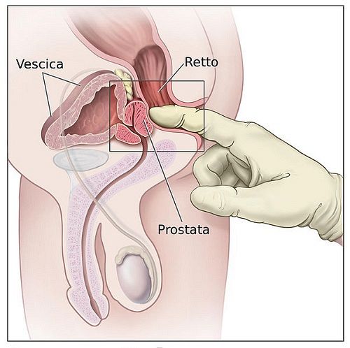 prostatita streptocidă examen de prostata en vivo