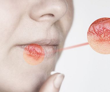 Herpes Simplex, cosa può causarlo e come si riconosce